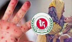 হামের উপসর্গে আরও পাঁচ শিশুর মৃত্যু